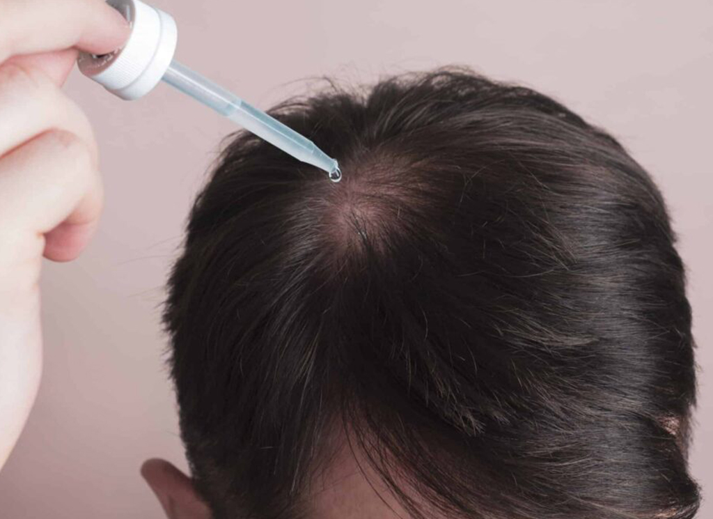 Hair Loss Treatments: Restoring Confidence and Volume