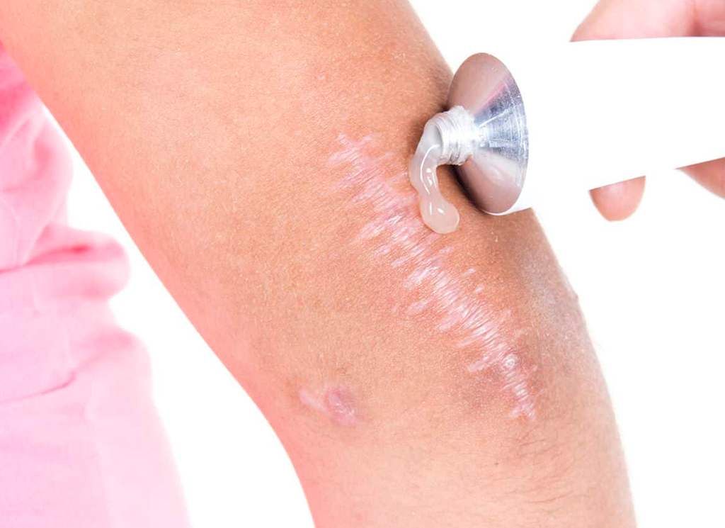 Compounded Scar Cream: Your Personalized Solution for Scar Treatment